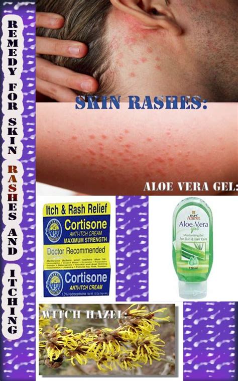 Natural Remedies to Easily Recover From Skin Rashes And Itching | Health and beauty, Natural ...