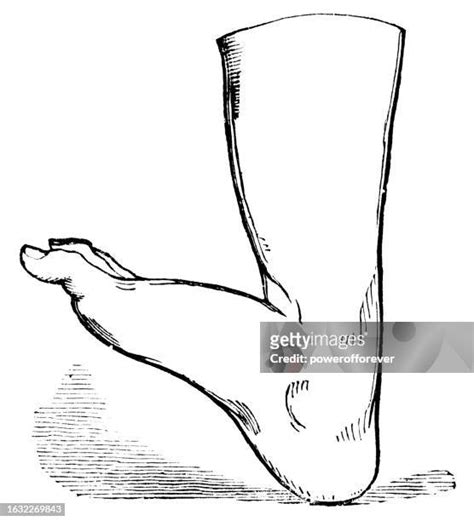 17 Clubfoot Treatment High Res Illustrations - Getty Images