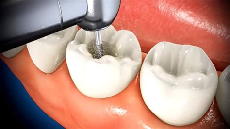 What To Expect When Getting A Root Canal | Marx Family Dental