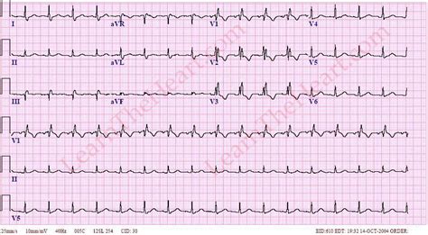 Right Bundle Branch Block (RBBB) ECG 1 | LearntheHeart.com