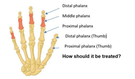 Hand Therapy - Phalangeal fractures of the fingers or thumb | Hull University Teaching Hospitals ...