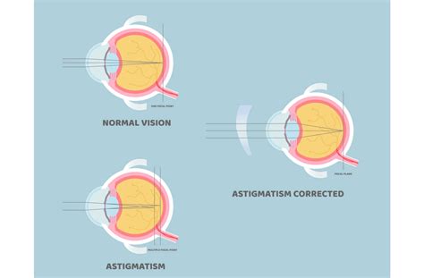 What Are Toric Contact Lenses? | Specialty Eye