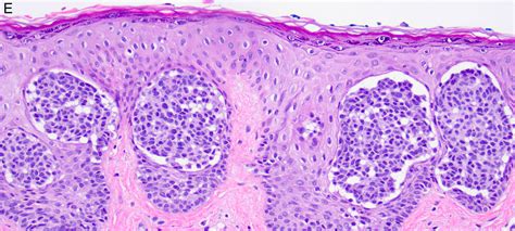 Nevus Comedonicus Histology