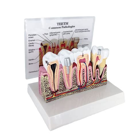 Buy Dental Model, Human Body Anatomy Replica Of Teeth, Dental Caries Teeth Model,Dental Anatomy ...