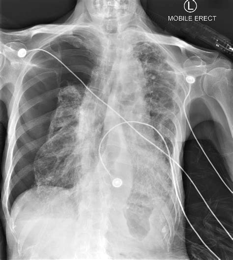 Pneumothorax Images X Ray - Briney Lucine