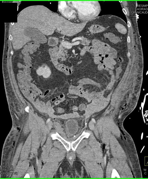 Hemoperitoneum in this Post Operative Patient - Genitourinary Case Studies - CTisus CT Scanning