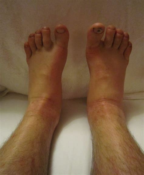 Benign Causes of Both Ankles Being Swollen & Puffy and Treatment ...