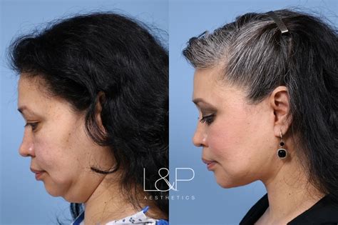 Drs. Lieberman and Parikh consistently get robust and natural results by suggesting the right ...