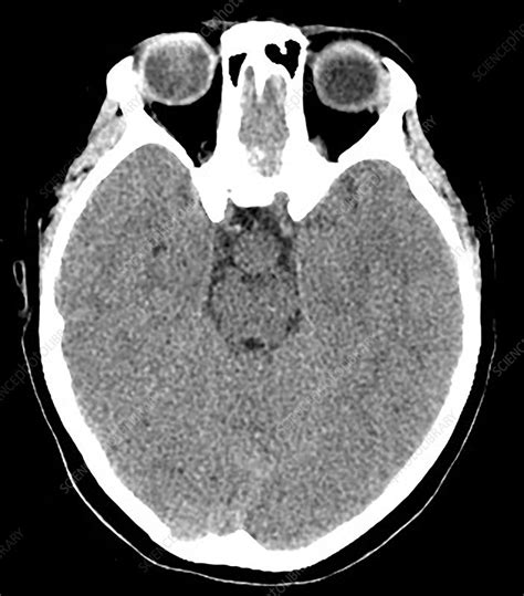 Hypothalamic Hamartoma, CT scan - Stock Image - C030/6376 - Science Photo Library