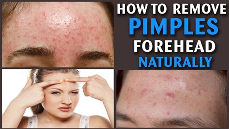 Get Rid Of Bumps On Forehead Overnight - get rid of bumps