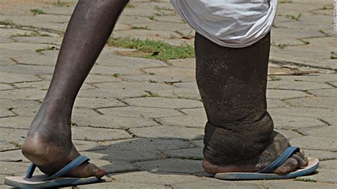 Every last worm: Eliminating Elephantiasis in India - CNN