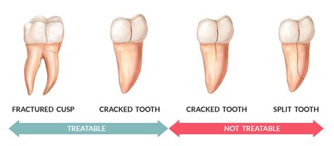 Is a Cracked Tooth Treatable? - Root Canal Treatment - Crown - Twinkle Family Dentalcare