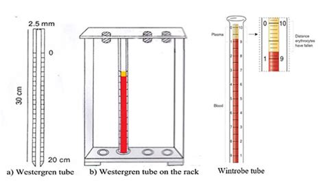 Erythrocyte sedimentation rate (ESR): principle, method, procedure and clinical application ...