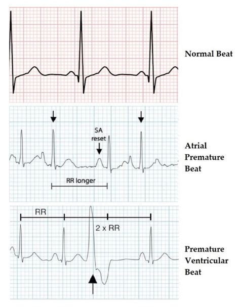 ECG waveforms of the three heartbeat classes. | Download Scientific Diagram