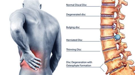 Chronic Lower Back Pain - Causes, Symptoms and Treatments