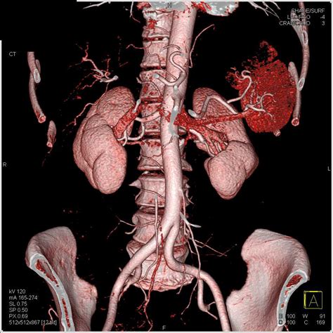 What Is A Pet Scan Of The Kidney