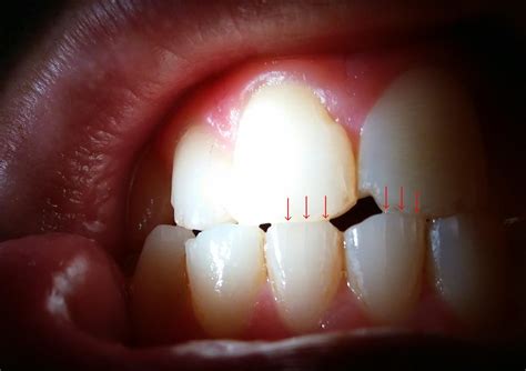 Cracked Tooth: Everything You Need To Know - Health - Nigeria