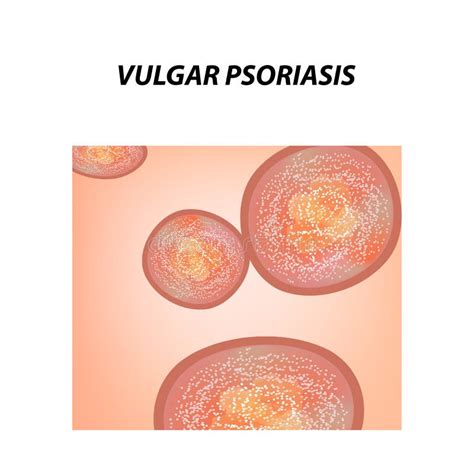 Psoriasis Treatment. Eczema, Dermatitis Skin Disease Psoriasis. Infographics. Vector ...