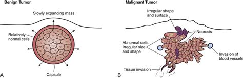 Neoplasms and Cancer | Basicmedical Key