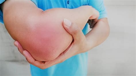 Soft Tissue Injuries: What You Need To Know