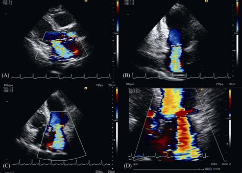 Mitral Valve Echocardiography