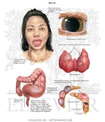 MULTIPLE ENDOCRINE NEOPLASIA TYPE 2 by Cèlia Güibas | MALALTIES GENÈTIQUES