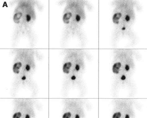 Renal Fellow Network: Nuclear Medicine Renal Imaging