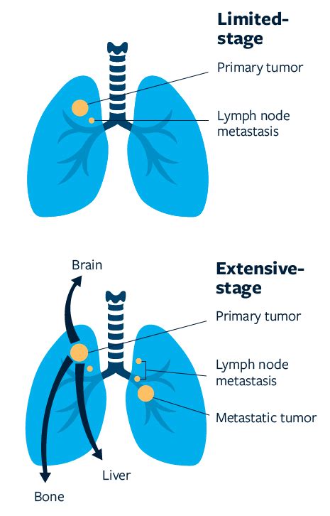 Lung Cancer Overview | Lung Cancer Research Foundation