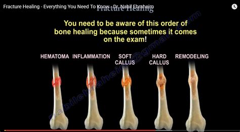 Bone Fracture Healing Stages