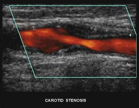 Ultrasound Of Carotid Artery