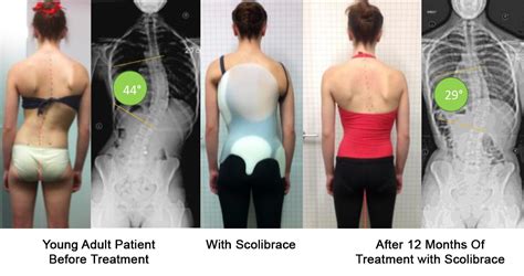 Scoliosis | Spine and Scoliosis Clinic