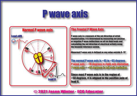 ECG Educator Blog : P axis on an ECG