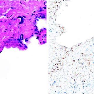 Histopathological and immunohistochemical analysis of the surgical... | Download Scientific Diagram