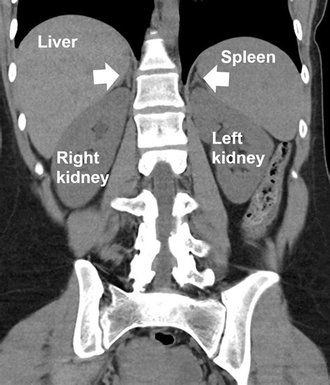 Anatomy of the Adrenal Glands: Where are Adrenal Glands and What do ...