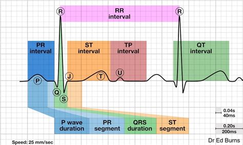 ECG: What about U waves? — Maimonides Emergency Medicine Residency