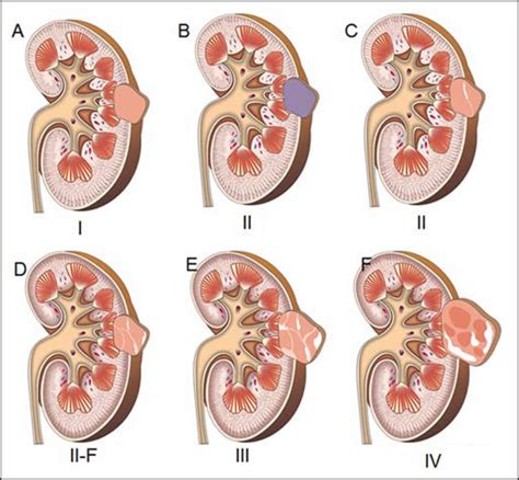 Kidney Cyst - Causes, Diagnosis, Symptoms, Complications & Treatment