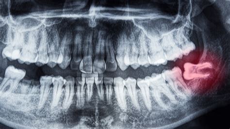 tea tree oil cure toothache - Karan Arellano