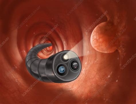 Colonoscopy with Polyps - Stock Image - C022/1033 - Science Photo Library