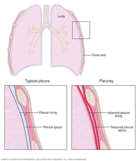 Pleurisy - Symptoms and causes - Mayo Clinic