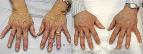 Hand Lift Before and After Pictures Case 938 | Paramus, New Jersey | Parker Center for Plastic ...