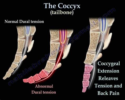 Coccydynia - Health - Nigeria