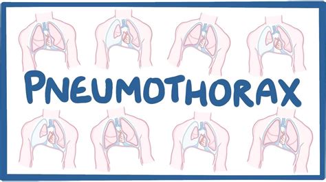 Pneumothorax - causes, symptoms, diagnosis, treatment, pathology - YouTube