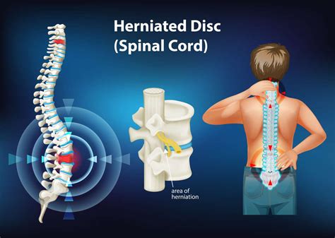 Disc Herniation: Symptoms, Diagnosis, How To Treat - MSK Health and Performance Clinics