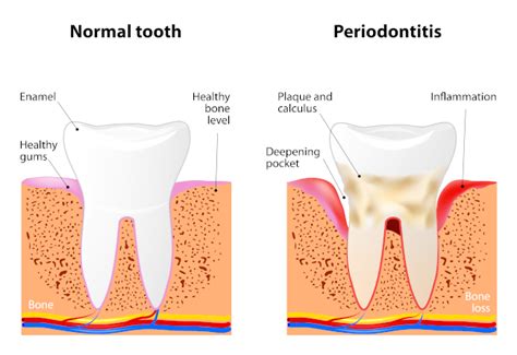 Pocket Reduction Surgery | Arizona Periodontal Group