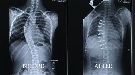 Health Watch: Scoliosis: Braces for The Spine - ABC30 Fresno