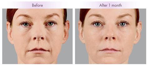 Using Fillers for Cheeks - Charleston Facial Plastic Surgery