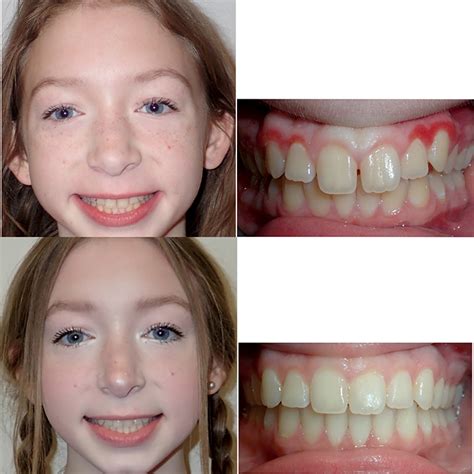 Before & After Braces | Wazio Orthodontics