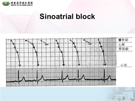 Arrhythmia :ECG ---Bradycardia_20120902_北區