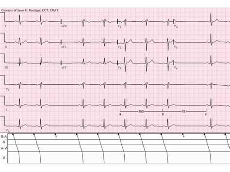 ECG Lecture: Sinus arrest, sinoatrial exit block, AV block and escape…