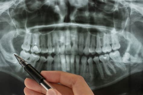 Preparing for Wisdom Teeth Surgery | OC Dentist - Blog